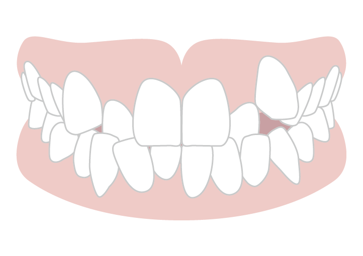 叢生（乱ぐい歯）