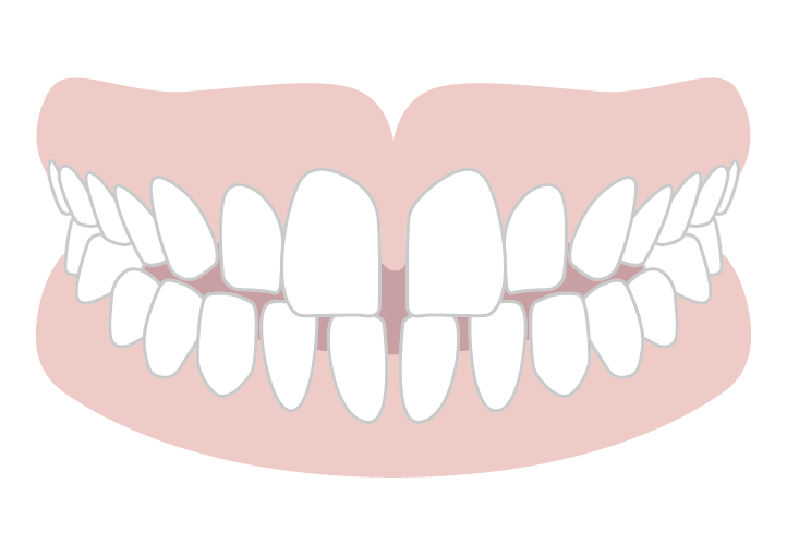 空隙歯列（すきっ歯）