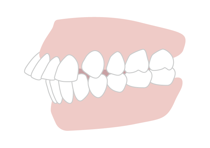 出っ歯（上顎前突）