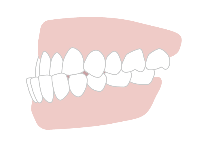 下顎前突（受け口）
