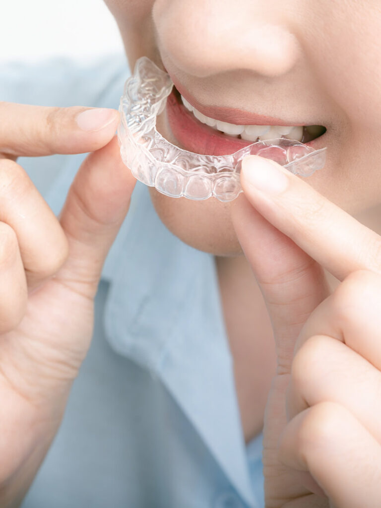 大阪・梅田の歯科医院_痛みの少ない取り外せるマウスピース矯正で歯並びを矯正してみませんか